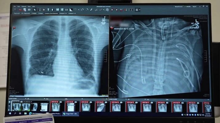 Patients-New-and-Old-Lung